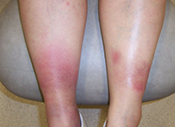 Fig. Leg lesions. Fig. Leg lesions.