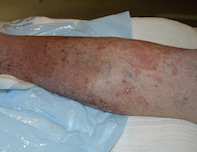 Tinea corporis Tinea corporis