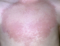 Rash. Rash.