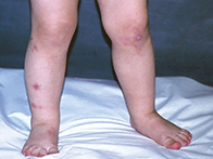 Fig. Itchy nodules. Fig. Itchy nodules.