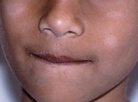 Fig. Hypopigmentation. Fig. Hypopigmentation.
