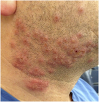 Fig 1. Vesicles and pustules. Fig 1. Vesicles and pustules.