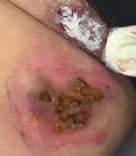 hidradenitis suppurativa hidradenitis suppurativa