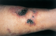 Fig 1. Skin necrosis Fig 1. Skin necrosis