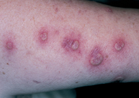 Fig 1. Pustular lesions Fig 1. Pustular lesions