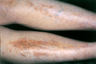 Fig 1. Pigmented patches Fig 1. Pigmented patches