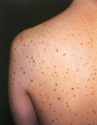 Fig 1. Red-brown lesions Fig 1. Red-brown lesions
