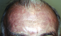Fig 1. Slate-grey pigmentation Fig 1. Slate-grey pigmentation