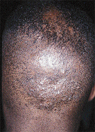 Fig 1. Follicular cysts Fig 1. Follicular cysts