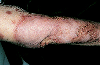 Fig 1. Annular scarring Fig 1. Annular scarring