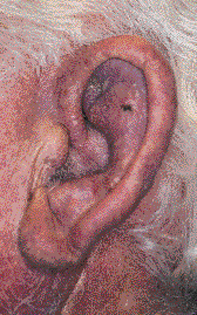 Fig 1. Dusky erythema Fig 1. Dusky erythema