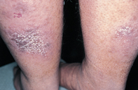 Fig 1. Violaceous plaques Fig 1. Violaceous plaques