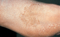 Fig 1. Tan patch Fig 1. Tan patch