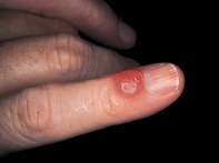 Fig 1. Translucent cyst Fig 1. Translucent cyst