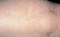 Fig 1. Keratoses Fig 1. Keratoses