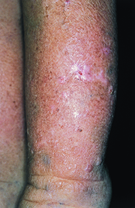 Fig 1. Pretibial skin Fig 1. Pretibial skin