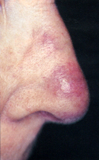 Fig 1. Nodule on nose Fig 1. Nodule on nose