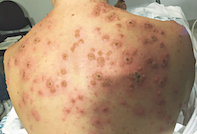 Fig 1. Fig 1. Hyperpigmented skin.